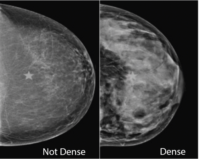 The Federal Breast Density Inform Rule: Huge Leap Forward, But More To Do –  Volpara Health